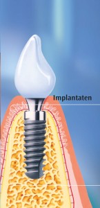 implantaten